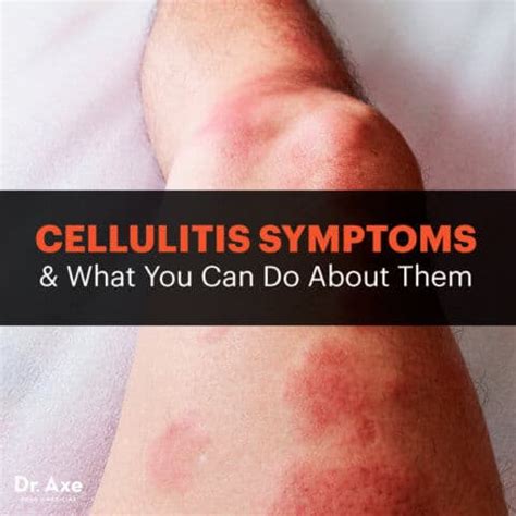 Cellulitis Symptoms, Causes & Risk Factors - Dr. Axe