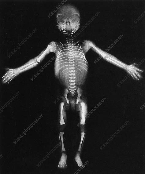 Skeleton of a baby - Stock Image - M815/0345 - Science Photo Library