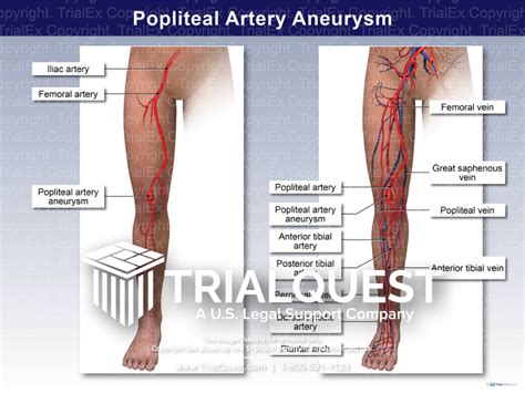 Popliteal Artery Aneurysm - TrialExhibits Inc.