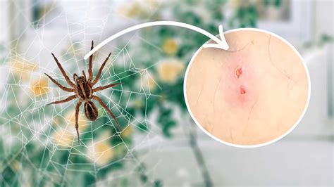 15 Types Of Spider Bites: Identification Chart with Picture