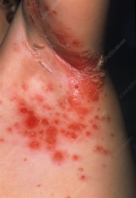 Young boy with impetigo around his armpit - Stock Image - M180/0087 - Science Photo Library