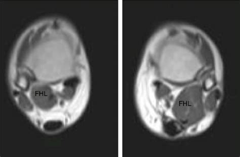 Marked hypertrophy of the flexor hallucis longus (FHL) muscle 3 years ...