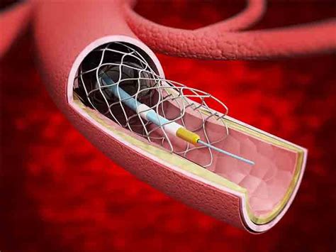 Which of These Describes Why a Stent Is Used