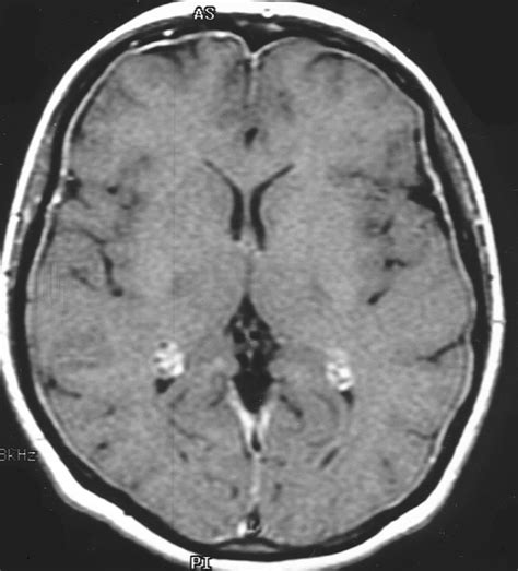 MRI Protocols: Meningitis MRI Protocol