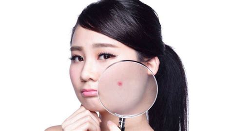 Best Acne Nodule Treatment - Guide For Your Skin Problem