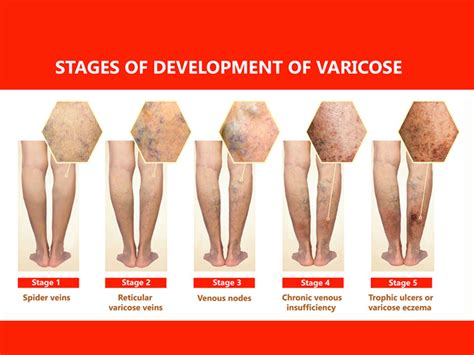 Venous Stasis Ulcer Vs Arterial Ulcer