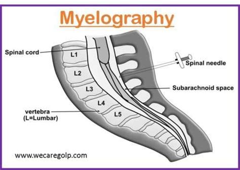 Myelography (Myelogram) - We Care