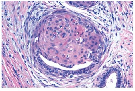 Metaplastic Carcinoma Including Low-grade Adenosquamous Carcinoma | Basicmedical Key