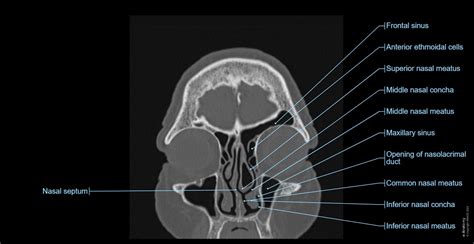 Cranial Bone Anatomy Ct Axial