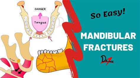 Bucket Handle Fracture