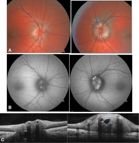 The swollen optic nerve: an approach to diagnosis and management ...