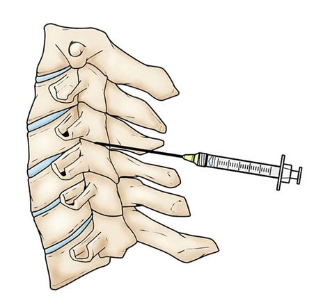 Cervical Spondylosis (Arthritis of the Neck) - OrthoInfo - AAOS