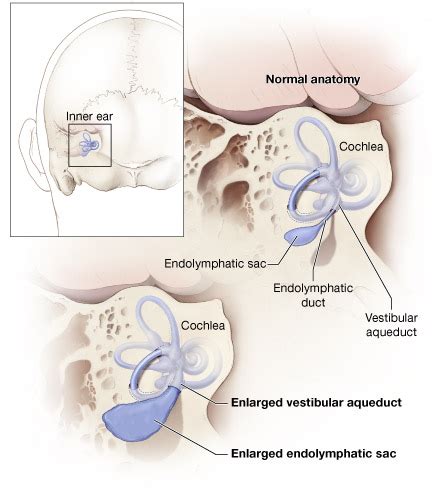 Enlarged Vestibular Aqueducts (EVA) & Hearing Loss | NIDCD