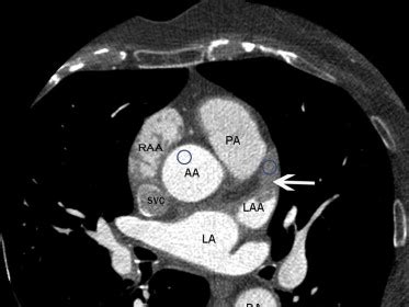 Comparison of Transesophageal Echocardiography Versus Computed ...