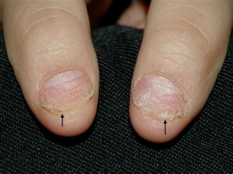 Nail psoriasis