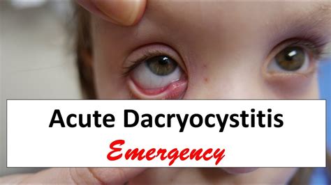 Acute Dacryocystitis Emergency - YouTube