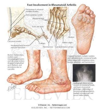 Rheumatoid Arthritis Foot Treatment | Los Angeles Foot Doctor