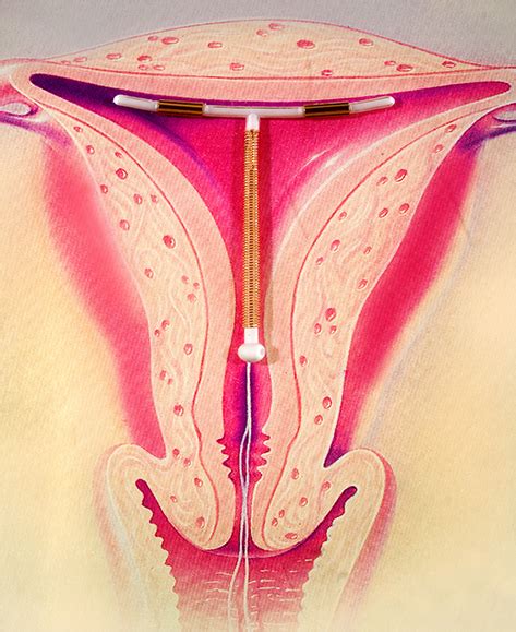 Intrauterine contraceptive device (IUD) | healthdirect