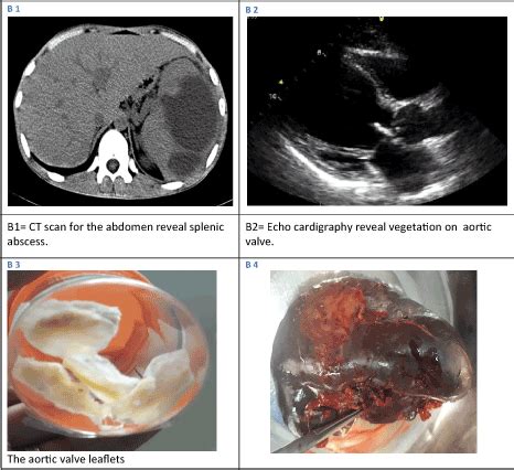 Simultaneous surgery is effective treatment and could be the management of choice in patients ...