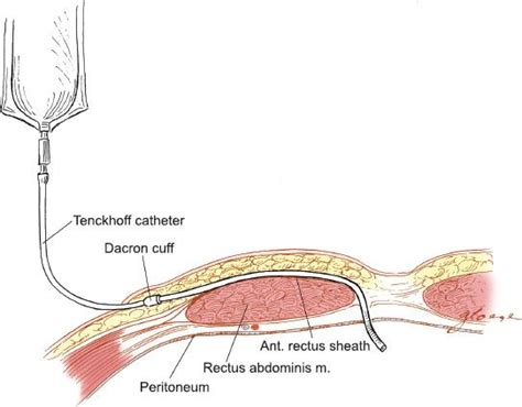 Surgical Techniques | Oncohema Key