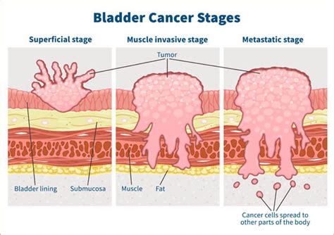 Bladder Cancer Survival: The Importance of Early Detection | Cxbladder