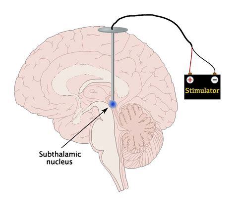 Remote Brain Stimulation: A new treatment for Parkinson’s disease? - Science in the News