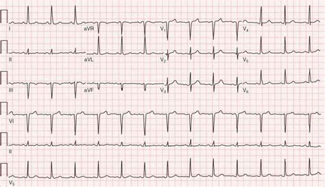 Echocardiographic Assessment of the Patient With Known or Suspected Congestive Heart Failure ...