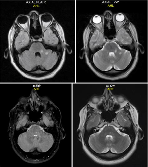 MRI of the brain showing the demyelination lesions before (top row) and ...