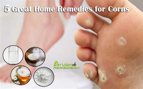 5 Home Remedies for Corns on Feet, Toes, Hands and Fingers