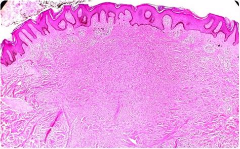 Dermatofibroma Presentation