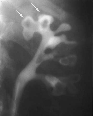 Renal Papillary Necrosis - USMLE Strike