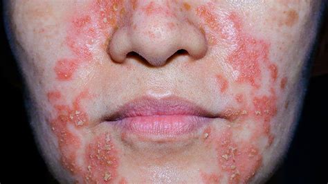 Eczema In Pictures: What Do the Types Look Like?