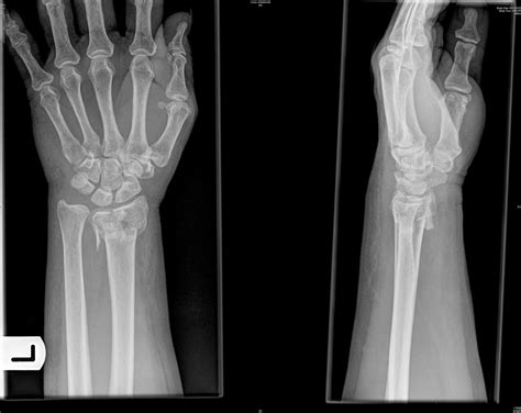 Left Colles Fracture