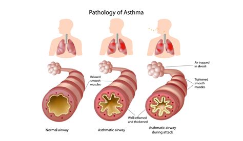 What Causes Asthma Flare Ups - Know Your Asthma