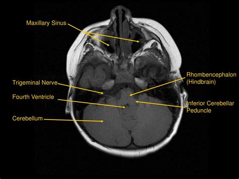 PPT - MRI of Brain/Head and Neck PowerPoint Presentation, free download - ID:601876