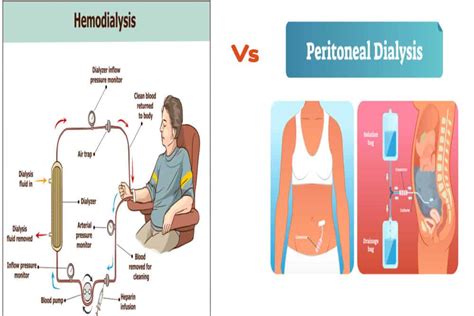 Peritoneal Dialysis Vs Hemodialysis: EASY To Understand Article