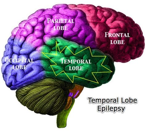 Types of Epileptic Seizures - HubPages