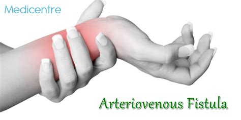 Arteriovenous Fistula - Causes, Symptoms & Treatments