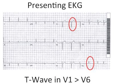 EKG Subtlety: Tall T-Wave in Lead V1