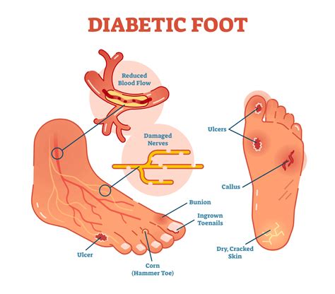 Diabetic Foot Care Tips | Preferred Foot & Ankle