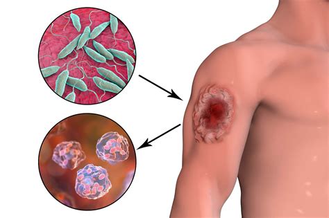 Topical 15% Paromomycin-Aquaphilic Effective For New World Leishmaniasis - Infectious Disease ...