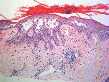 Actinic Keratosis Histology