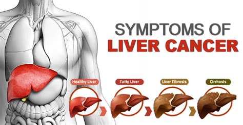 Symptoms of Liver Cancer and Prevention Measures to Take!