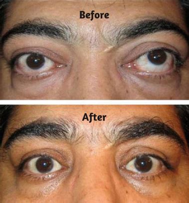 Squint Eye Treatment for Adults | Causes, Methods and Risks | Eyemantra