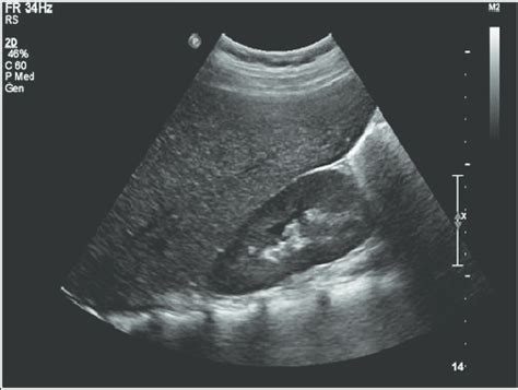 Abdominal ultrasonography showing hepatomegaly with increased hepatic... | Download Scientific ...