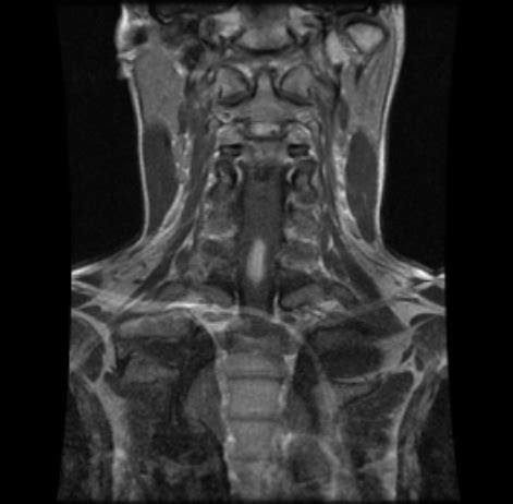 MRI of the cervical spine, coronal view: contrast enhan | Open-i