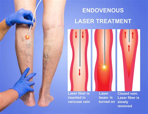 Varicose Veins | Spider Veins Treatment in Ulhas Nagar | Surekha ...