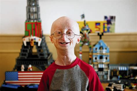 Sam Berns dies at 17; subject of film about genetic condition progeria ...