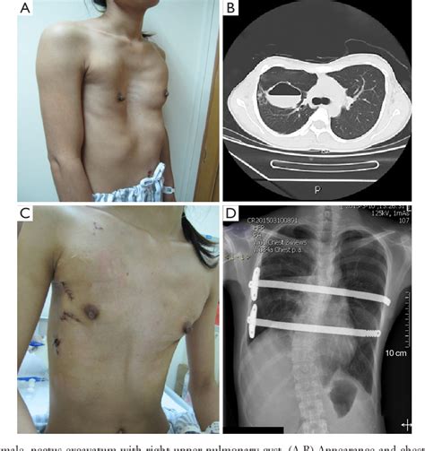 Figure 8 from Surgical correction of 639 pectus excavatum cases via the Nuss procedure ...