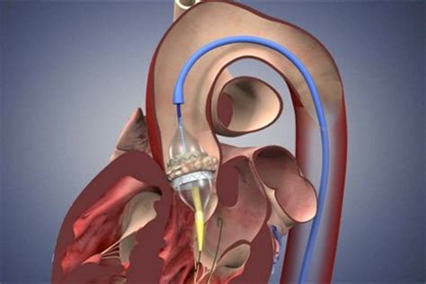 Cardiologie: la pose de bioprothèses par cathéter prometteuse | Médecine